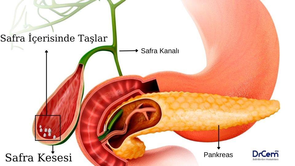 Kolelitiazis görseli - DrCem hastalık rehberi
